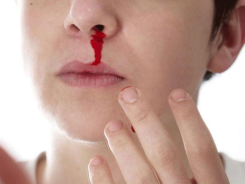Chảy máu mũi liên tục: Cảnh giác u xơ mũi họng | Vinmec