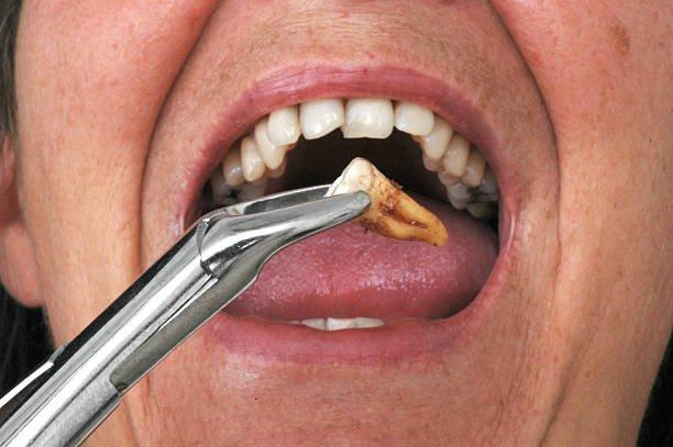 Những điều cần biết về nhổ răng sâu hàm trên | Vinmec