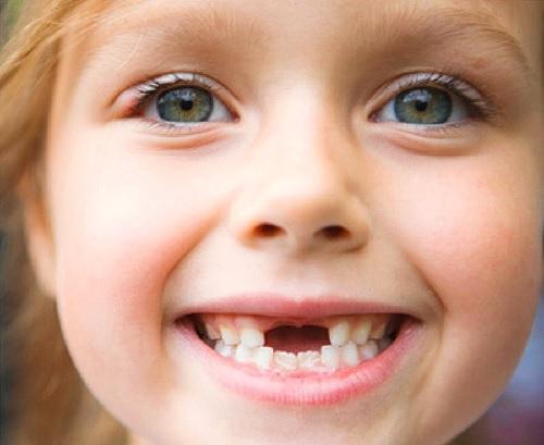 5 mẹo để con có hàm răng đều, không khấp khểnh, hô móm - hih.vn