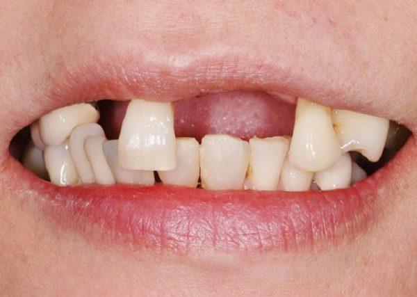 Nguyên nhân gây rụng răng là gì? Răng rụng có mọc lại không? - Nha khoa  Thùy Anh