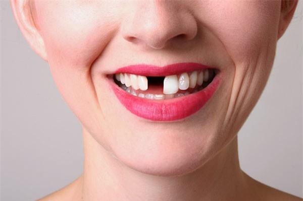 Mơ thấy rụng răng – đừng coi thường vì nó nghiêm trọng hơn bạn tưởng | Tin  tức Online