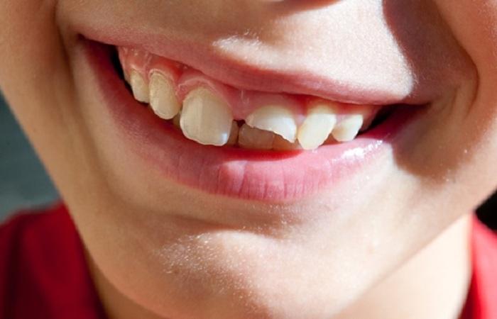 Răng bị gãy còn chân răng phải làm sao? 4 cách điều trị tốt nhất