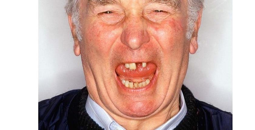 Lý do người cao tuổi hay bị đau răng, rụng răng?